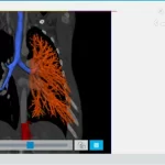 Articolo Stampa 3D in clinica 3