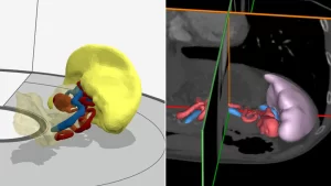 Bio3DModel Intervento milza gallery 4