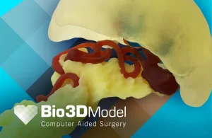 Bio3DModel Successo chirurgico Intervista_Chisci